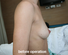 plastic-surgery-breast-augmentation
